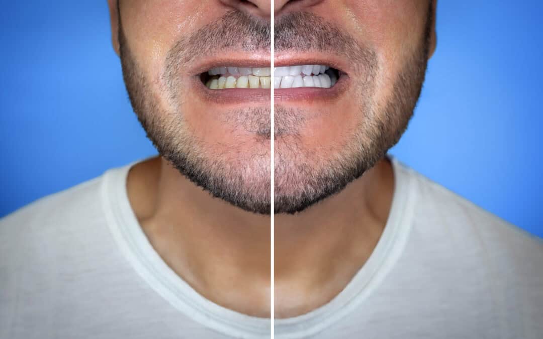 Does Teeth Whitening Damage Enamel? Discover the Truth Now!